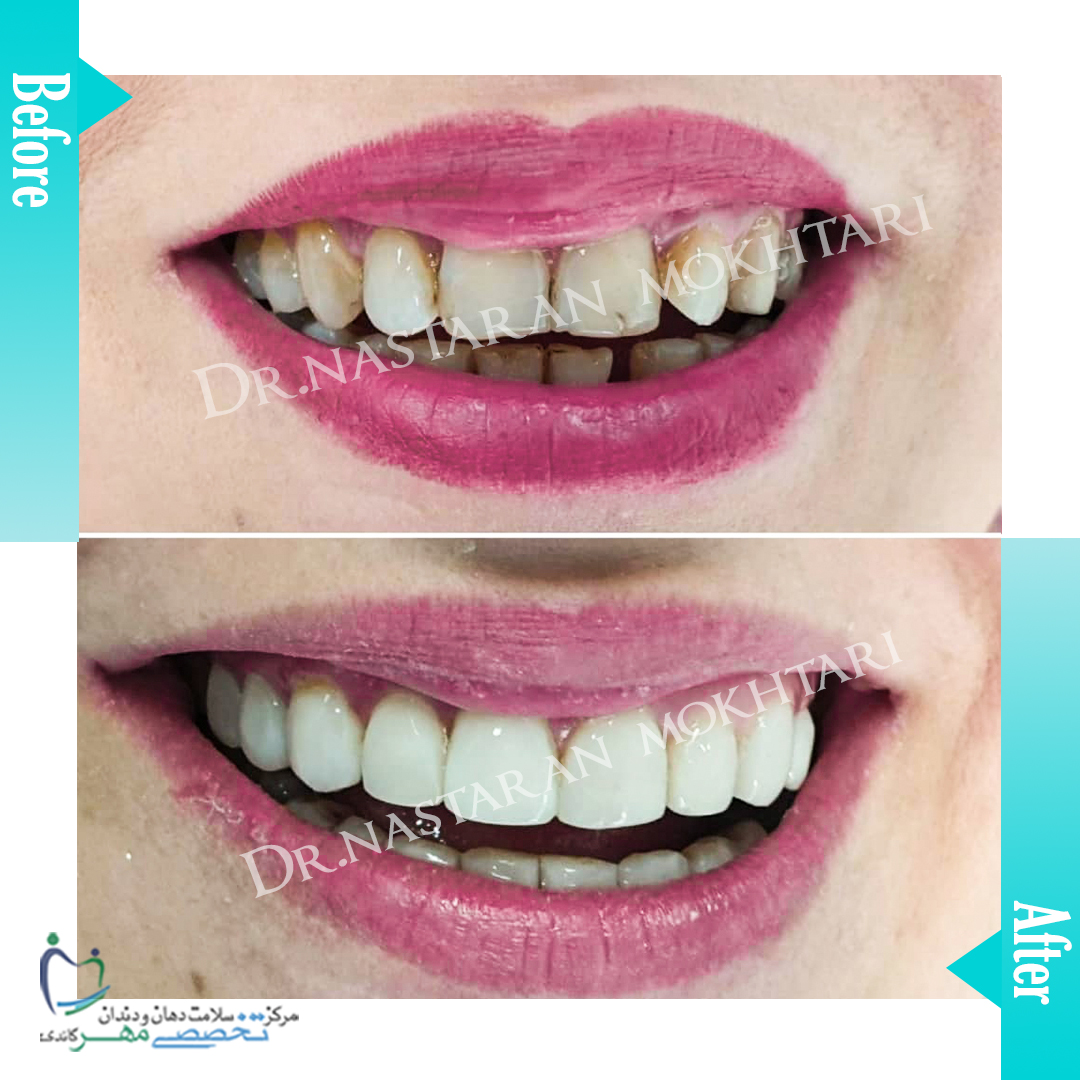 دکتر نسترن مختاری - متخصص ترميمی و زیبایی (کامپوزیت ونیر / لمینیت کامپوزیتی)